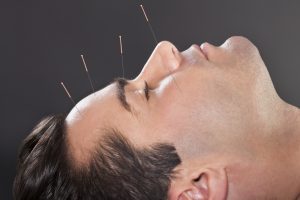 acupuncture benefits for physical therapy