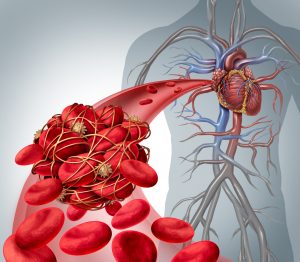 Blood clot risk medical illustration 