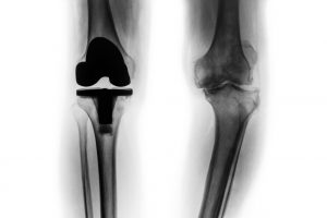 Film x-ray knee and Total knee replacement