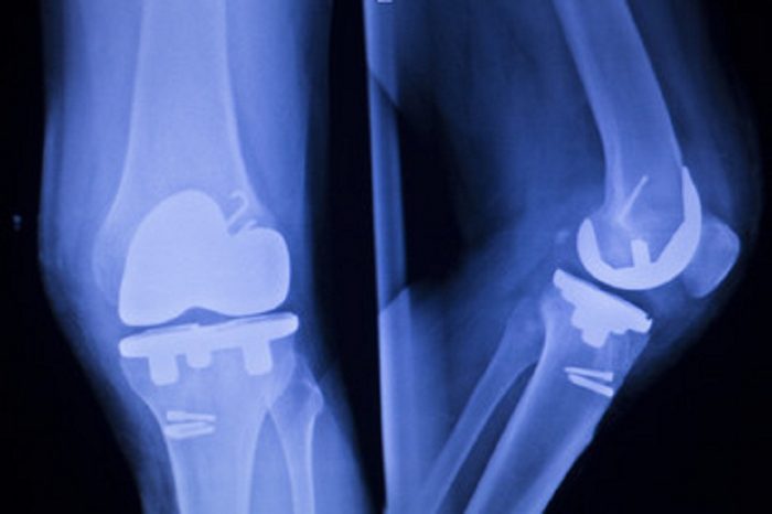 Which Is Better Total Or Partial Knee Replacement