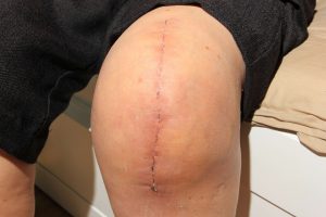 Knee scar