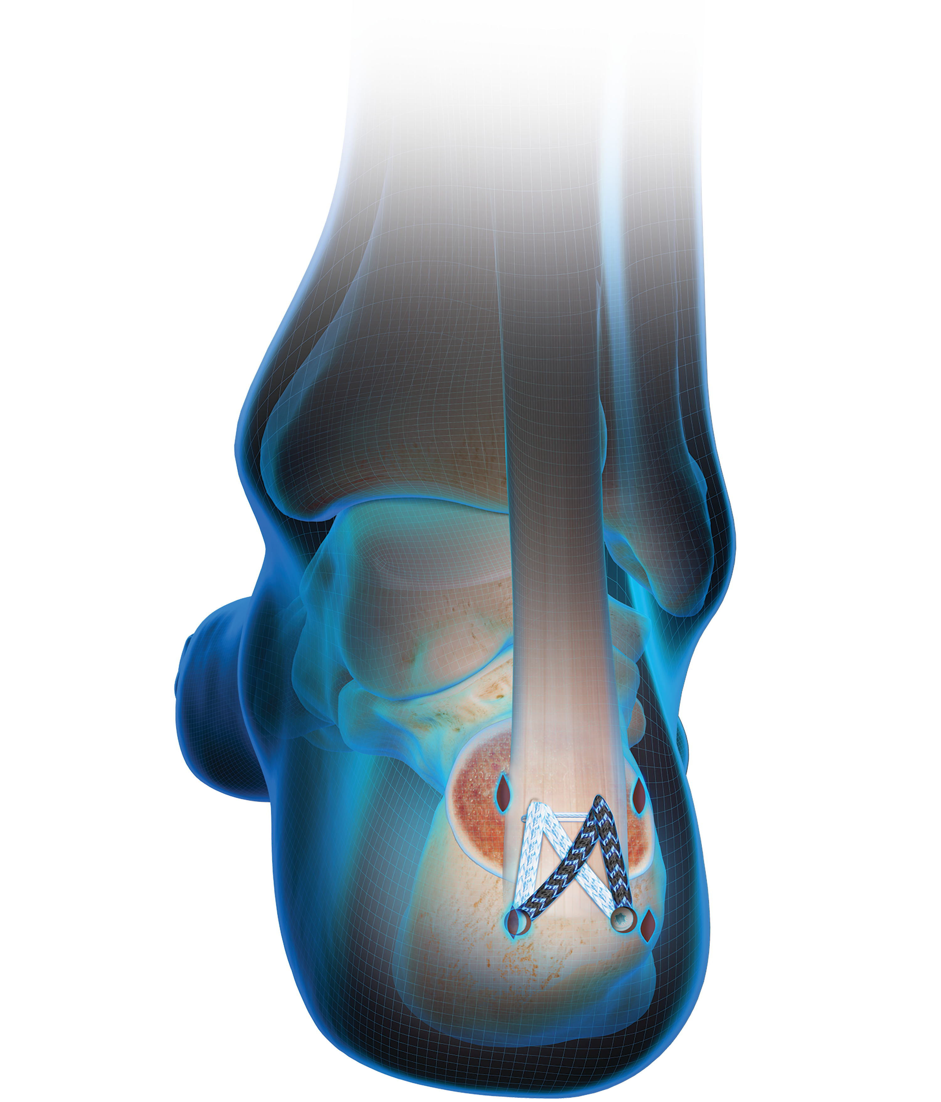 MIS Achilles Blue Wire Illustration